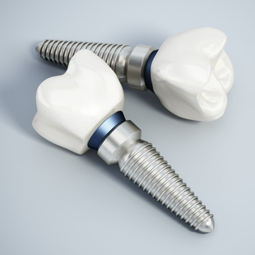 dental implant questions